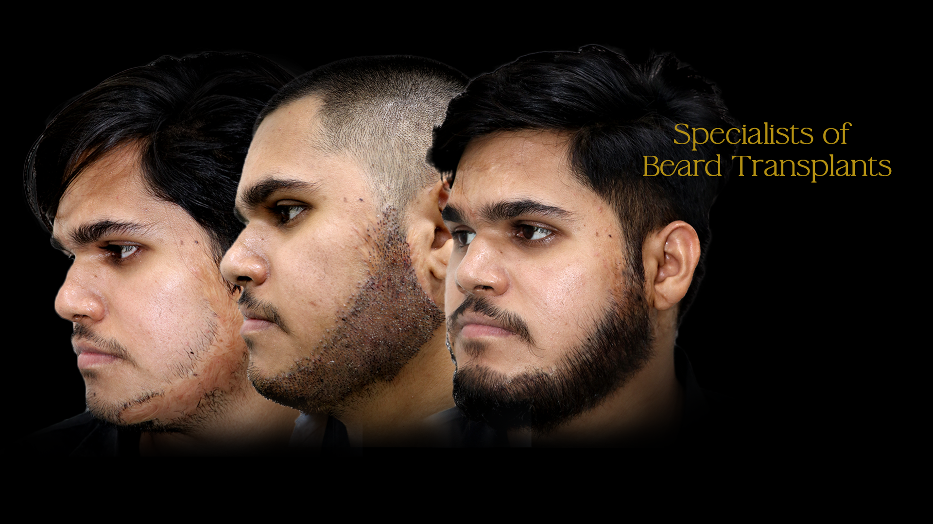 Hair Transplant Cost in Pune 3