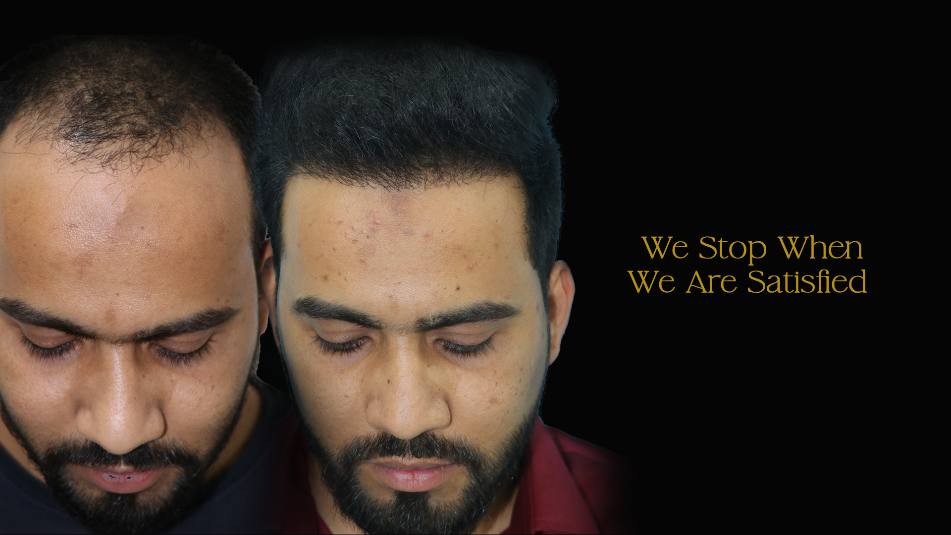 Hair Transplant Cost in Pune 4