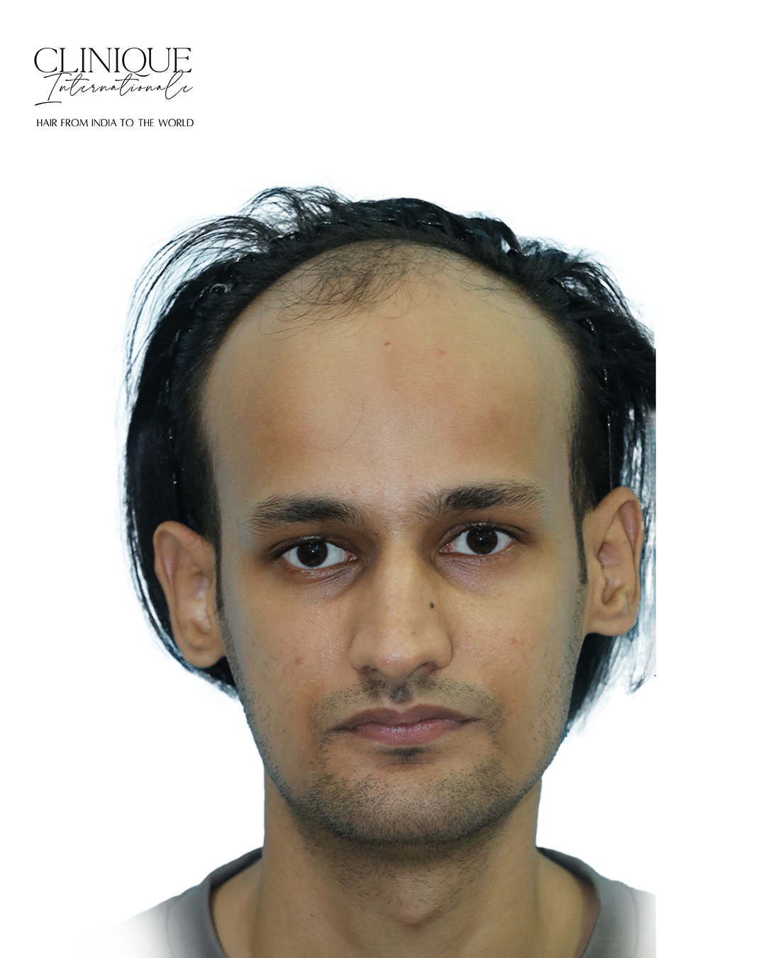 Patient before hair transplant