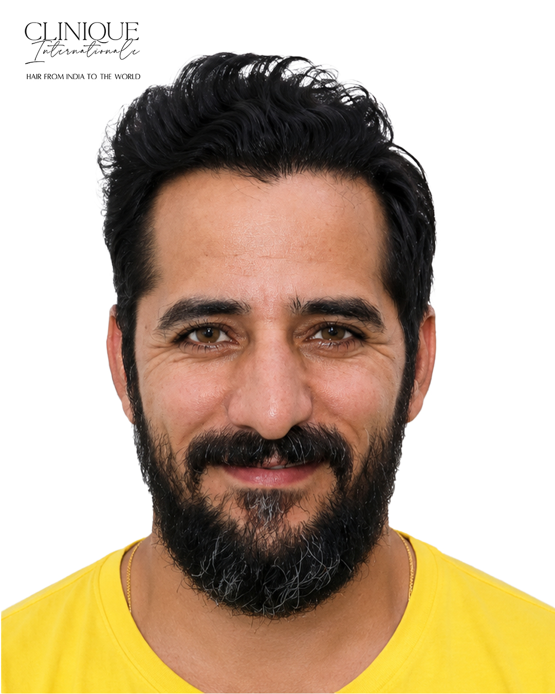 Patient after hair transplant