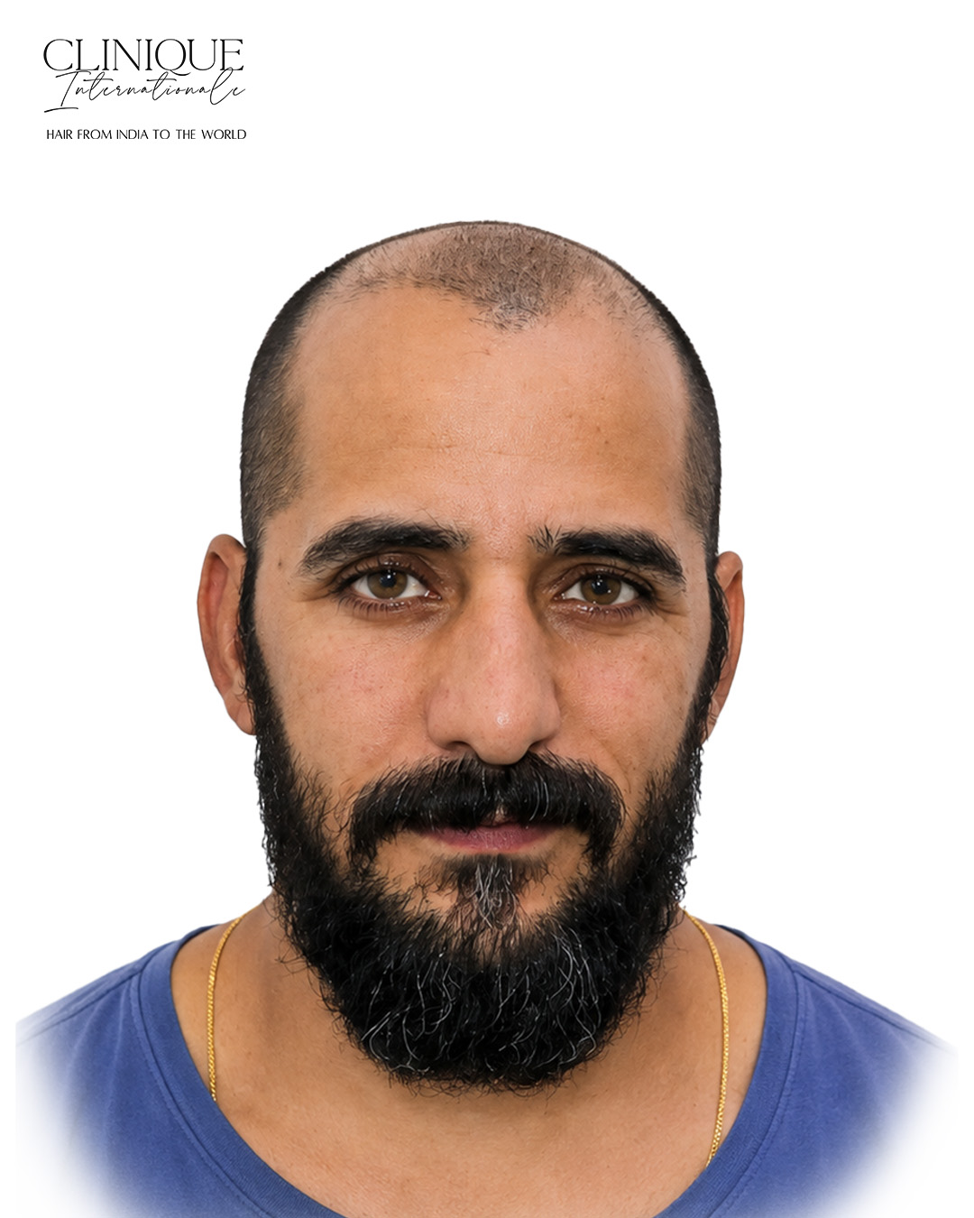 Patient before hair transplant